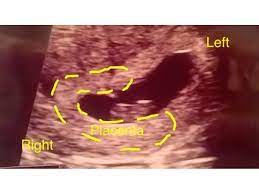 Can You Predict Your Baby's Sex With The Ramzi Theory? | Babycenter