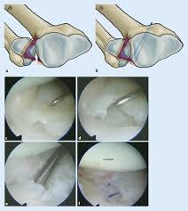 Tears due to wear are the most common and are usually not seen in younger people. Nahttechniken Am Diskus Springerlink