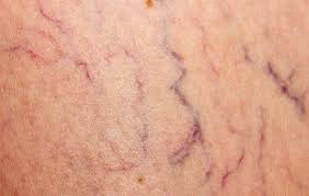 We did not find results for: If You Ve Ever Considered Taking Vitamin K For Spider Veins You Need To Read This Prevention