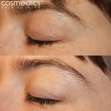Image result for xanthelasma of eyelid