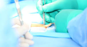 اعراض الفتق وأنواعه وعلاجاته تعرف عليها ويب طب