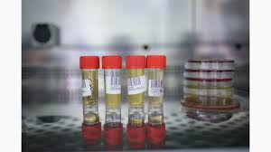 Identificarea unor disfunctii renale, urinare, hepatice, metabolice. Examen Complet De UrinÄƒ Sumar Sediment ProvidenÈ›a PoliclinicÄƒ È™i Spital