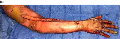 The ideal side to perform escharotomy allows for preservation of pinch i. Escharotomy In Burns Chapter 48 Atlas Of Surgical Techniques In Trauma