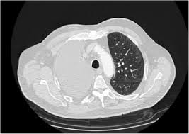 Typical mesothelioma settlements and verdicts range from $1 million to $2.4 million. Cancer De Pulmon Microcitico Otros Tumores Toracicos Mesotelioma Timoma Y Tumores Germinales Mediastinicos Sciencedirect