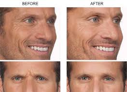 Botox® Injections in MN