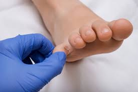 Image result for dyshidrosis