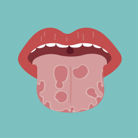 840+ Mouth Cancer Ilustraciones de Stock, gráficos vectoriales libres de derechos y clip art - iStock