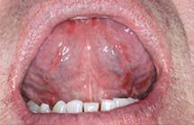 Image result for Fissured tongue