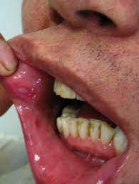 Behcet S Disease Wikidata