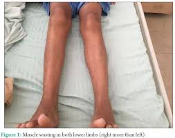 Image result for Polymyositis