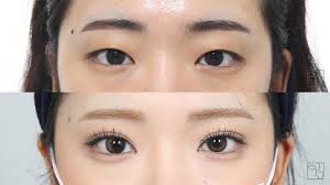 ❗️쌍수 망한 사람들 95% 공통점? ✨ 예쁜 라인만 보고 수술함 라인만 예쁘면 다 될 줄 알았지? ➡️ 현실은 소.시.지 눈 ‼️  만명가량 수술한 의사가 꿀팁 풀어준다 주목 ‼️ 쌍꺼풀 라인 예쁜데 이상하게