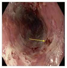 Animals with mild esophagitis generally have a favorable prognosis. Atypical Manifestation Of Herpes Esophagitis In An Immunocompetent Patient Case Report And Literature Review