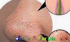 How To Get Rid Of Blackheads On Nose And Face Easily