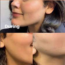 Five star laser is a premier center for laser hair removal that uses state of the art technology elite cynosure that treats all skin types for women and men. The Best 10 Hair Removal Near 271 10 Union Tpke Queens Ny 11040 Last Updated July 2021 Yelp