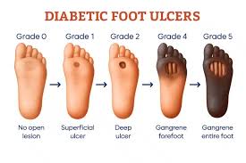 Image result for Wagner Ulcer Classification