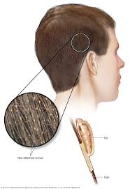 Although head lice are harmless and don't spread disease, they can cause a great deal of discomfort and distress. Head Lice Symptoms And Causes Mayo Clinic