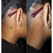 Tattoo excision is the full, surgical removal of tattooed skin. Top 10 Best Laser Tattoo Removal In Charlotte Nc Last Updated August 2021 Yelp