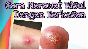 Meskipun beberapa orang percaya pengobatan rumahan dapat bekerja, belum ada penelitian formal yang dilakukan mengenai. Cara Merawat Bisul Dengan Berkesan Supaya Tak Berulang Youtube