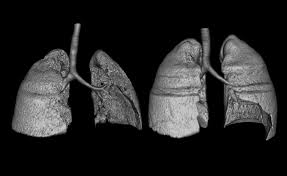 Shrinking Lung Syndrome As A Manifestation Of Pleuritis A New Model Based On Pulmonary Physiological Studies The Journal Of Rheumatology