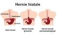 Hernie hiatale Socit gastro-intestinale uxdeventre. org