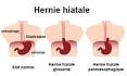 Remede hernie hiatal