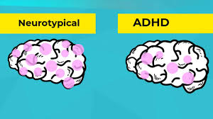 Certain brain structures related to emotion and reward are smaller in people with the disorder, new research finds. Infographics What Is Adhd Youtube
