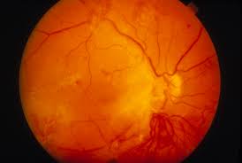 This is because diabetes can lead to eye problems, such as diabetic retinopathy. Diabetic Retinopathy Eye Disorders Msd Manual Professional Edition