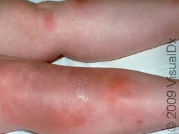 Image result for erythema nodosum