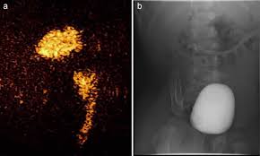 Image result for Voiding Cystourethrogram