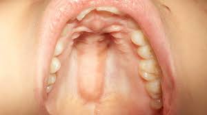 Jun 11, 2015 · food is either cooled or warmed to a suitable temperature in the mouth. Torus Palatinus Symptoms Diagnosis Causes And More