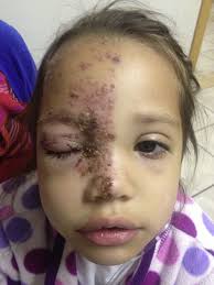 Herpes zóster oftálmico en paciente pediátrico sin inmunocompromiso