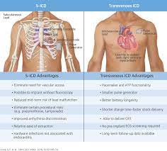 By sorin lazar, henry huang and erik wissner. Safety And Efficacy Of The Subcutaneous Implantable Defibrillator Sciencedirect