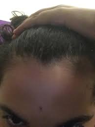 It will continue faster than you think. Is My Hairline Receding And If It Is How Do I Fix It Because I M Only 13 And That Would Suck To Have A Receding Hairline Already Hair