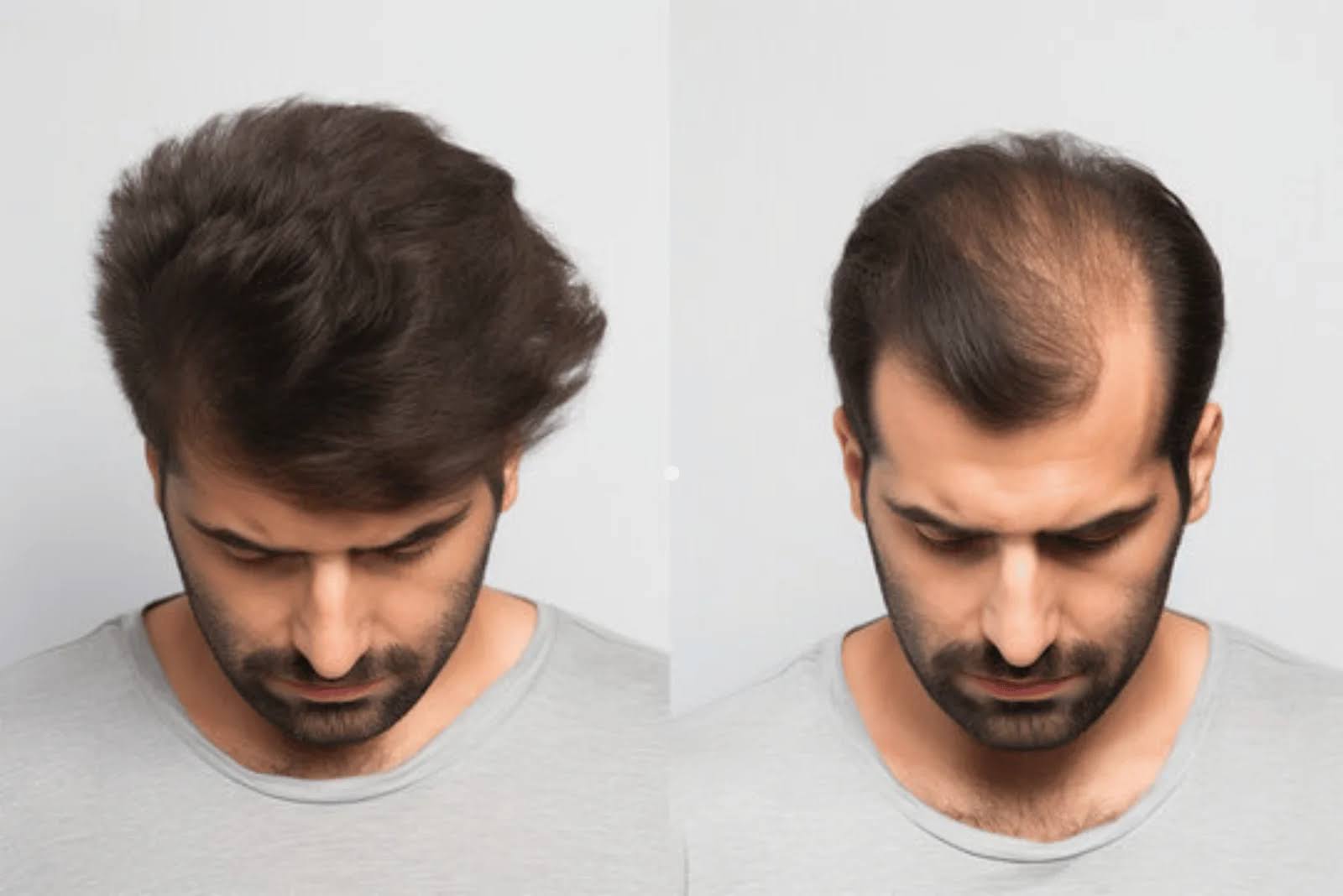 Hair Bonding in Ahmedabad | Delight Hair Replacements product image