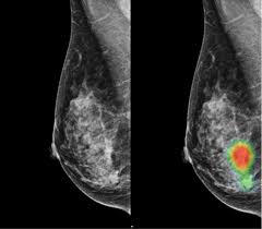 Abdominal ct scan is a diagnostic imaging technique that provides a clear picture of the state of internal organs located in the abdominal region. Ai Assisted Radiologists Can Detect More Breast Cancer With Reduced False Positive Recall Imaging Technology News