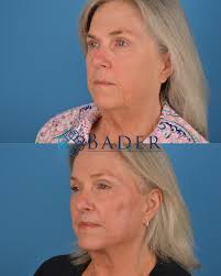 Bader Facial Plastic Surgery