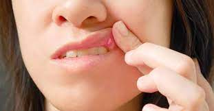 Some of the most common oral cancer symptoms and signs include: à´¤ à´£ à´Ÿà´¯ à´² à´• à´¨ à´¸à´° à´ˆ à´²à´• à´·à´£à´™ à´™à´³ à´…à´µà´—à´£ à´• à´•à´° à´¤ Cancer Cancer Prevention Cancer Treatment Prostate Cancer Breast Cancer Lung Cancer Cancer Symptoms à´• àµ»à´¸àµ¼ à´…àµ¼à´¬ à´¦ à´…àµ¼à´¬ à´¦