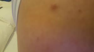 Knubbel Unter Der Haut