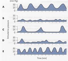 what is tetanic contraction during labor or how dns and