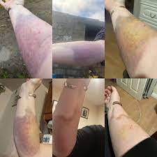 This can then lead to damage in your organs and finally organ failure. The Short Blonde On Twitter A Weeks Worth Of Arm Pics First Day It Happened To Tonight A Week Of Antibiotics Where Nurse Friends Were Panicking About Sepsis Risk Never Be Complacent