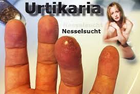 Nesselsucht Urtikaria Krankheitslexikon Gesund Co At