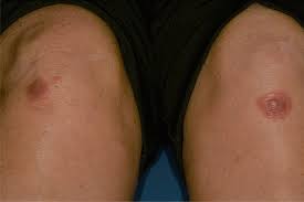 Image result for Erythema Multiforme