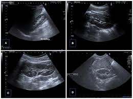 Frontiers Urinary Ultrasound And Other Imaging For Ureteropelvic Junction Type Hydronephrosis Upjhn Pediatrics