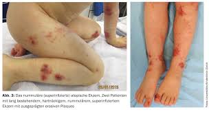 Image result for Eczema nummulare