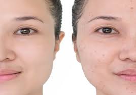 Pigmentation of the skin can occur just about anywhere on the body for a variety of reasons. Pigmentation Melasma Treatment Leading Skin And Aesthetic Clinic In Malaysia