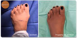 Lapidus bunionectomy and osteotomy tailor's bunionectomy performed with hammertoe correction of the 2nd toe. Before After Bunion Surgery Photo Gallery Los Angeles Foot Doctor Beverly Hills