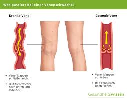 Venenschwache Ursache Symptome Diagnose Behandlung