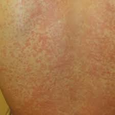 Pityriasis rosea is a type of skin rash. Man 25 With Sinus Pain Sore Throat And Rash Clinician Reviews
