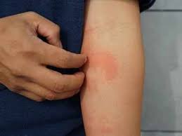 Some people see their skin swell and turn red or dark blue. Coronavirus Symptoms 5 Signs Of Skin Infection In Covid 19
