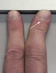 The index finger (also referred to as forefinger, first finger, pointer finger, trigger finger, digitus secundus, digitus ii, and many other terms) is the second finger of a human hand. Bilateral Index Finger Clinodactyly As A Teaching Tool For Internal Jugular Vein Anatomic Landmarks Journal Of Cardiothoracic And Vascular Anesthesia